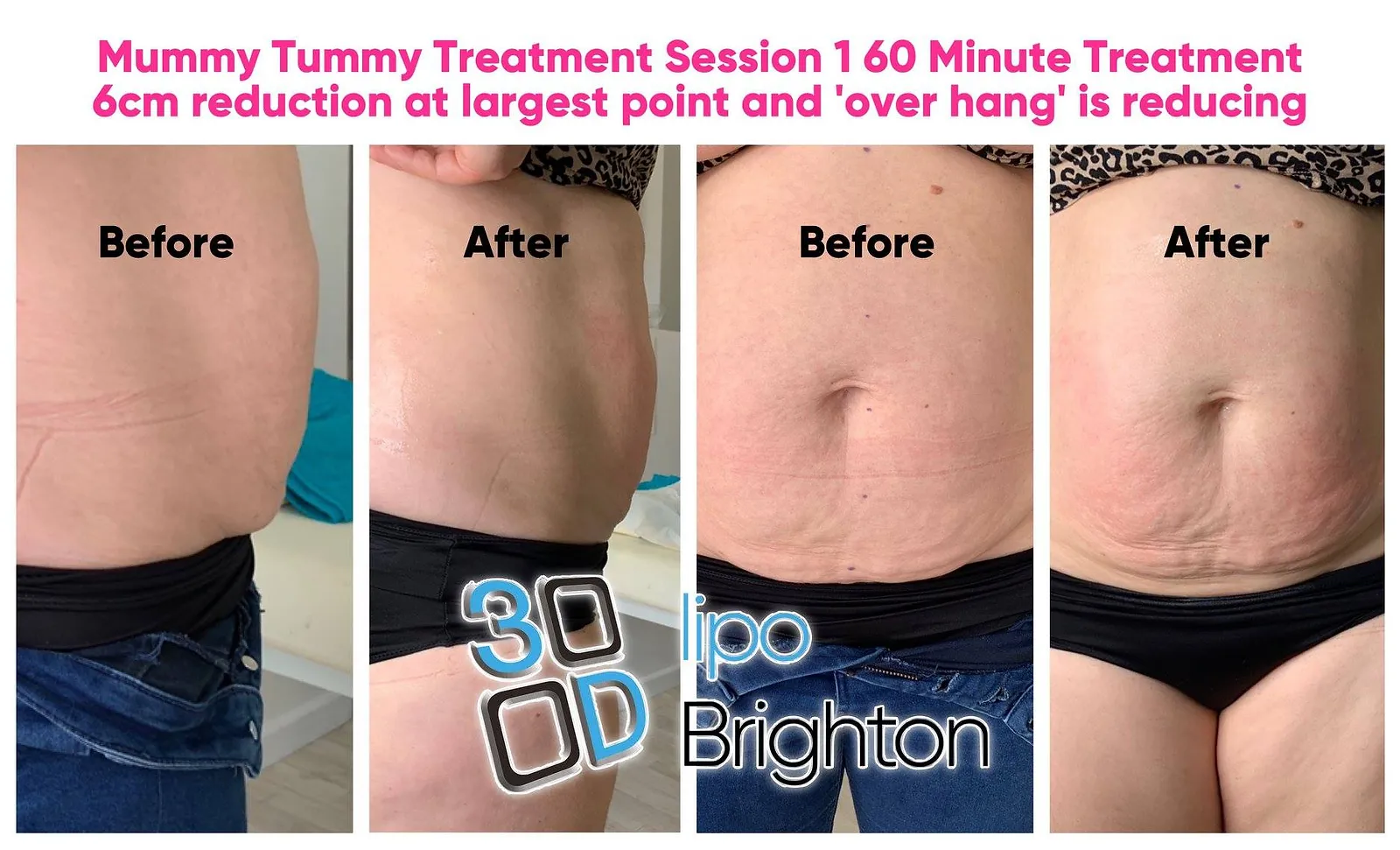 Mummy Tummy at 3d Lipo brighton.jpg